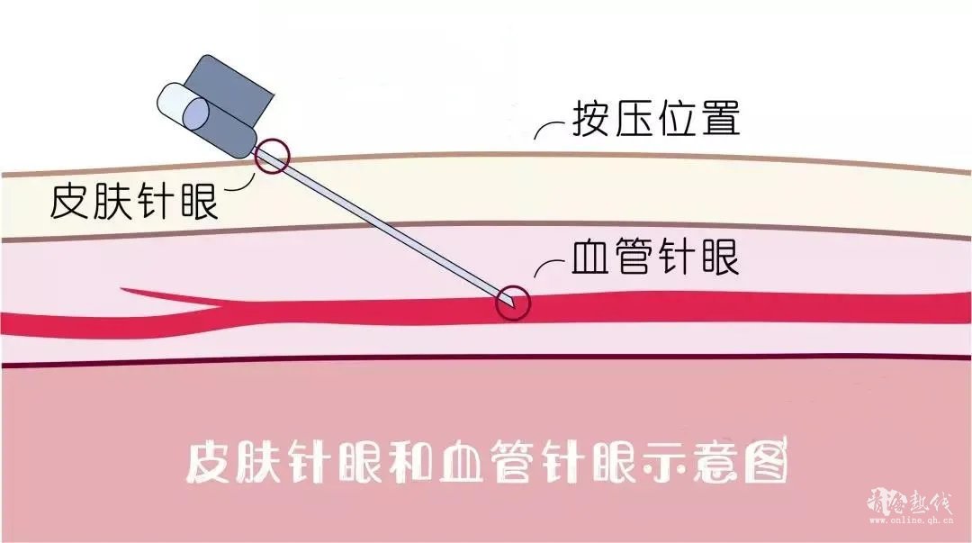  献血时会出现的“意外”→_→手臂淤青咋回事 